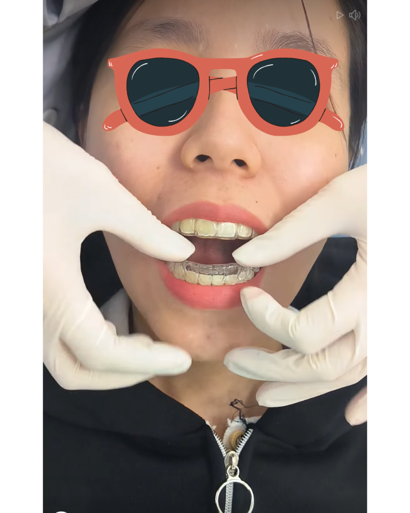 Bệnh nhân đang đeo khay Invisalign tại Nha Khoa Quỳnh Nha